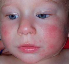 어린이의 알레르기 및 주요 증상