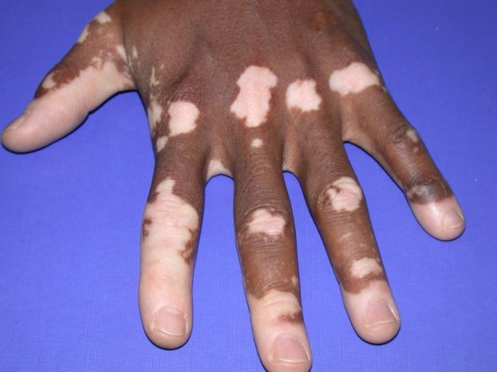 Vitiligo의 원인