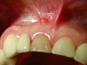 유용한 정보 : 치아 추출 후 폐포 염